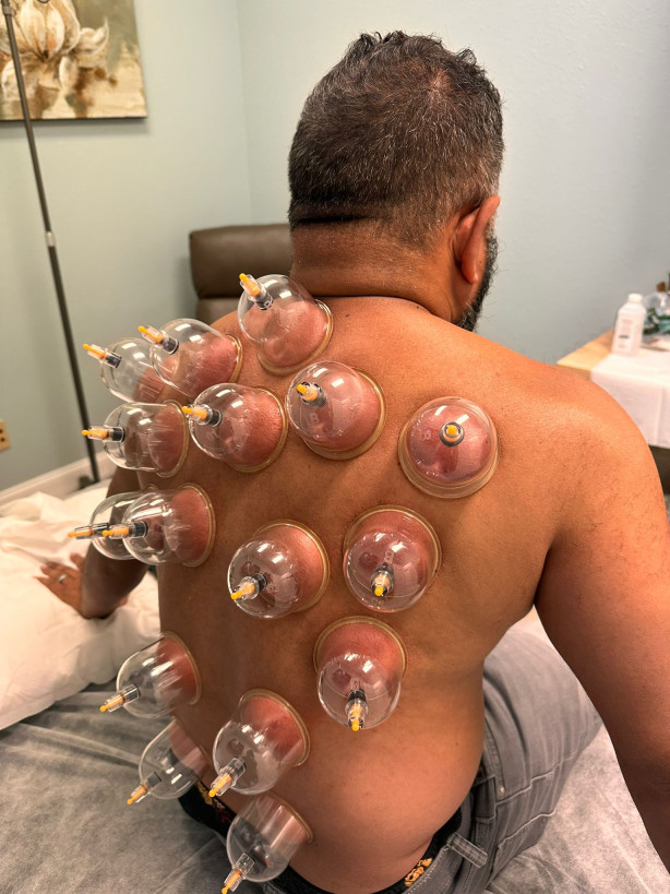 Hijama Session