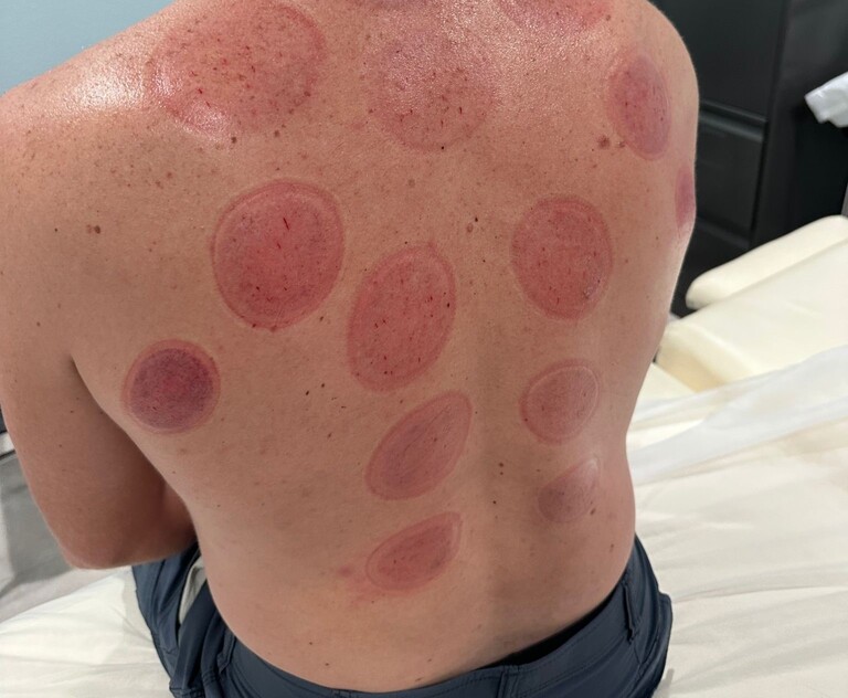 Sports Cupping