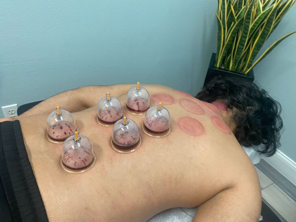 Wet Cupping